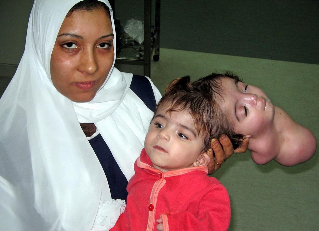 A nurse hold an Egyptian baby named Manar Maged in a hospital in the city of Banha, 40 km, 25 miles, north of Cairo February 18, 2005. Egyptian doctors said they removed a second head from a 10-month-old girl suffering from one of the rarest birth defects in an operation on Saturday.   Maged was in a serious but improving condition after the procedure to treat her for craniopagus parasiticus -- a problem related to that of conjoined twins linked at the skull.   As in the case of a girl who died after surgery in the Dominican Republic a year ago, the second twin had developed no body. The head that was removed from Manar had been capable of smiling and blinking but not independent life, doctors said.  Picture taken Feb. 18  REUTERS/Str