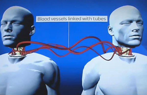 worlds-first-human-head-transplant-to-take-place-in-8-months-23